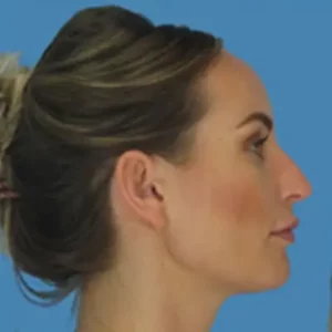 Before Image: Rhinoplasty