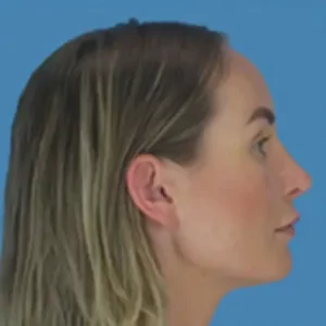 After Image: Rhinoplasty