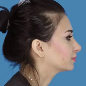 After Image: Rhinoplasty
