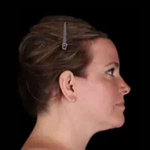 After Image: Neck Lift