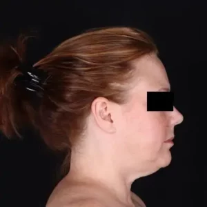Before Image: Neck Lift