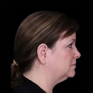 Before Image: Neck Lift