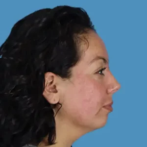 After Image: Rhinoplasty