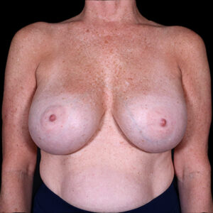 After Image: Breast Augmentation