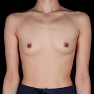 Before Image: Breast Augmentation