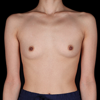 Before Image: Breast Augmentation - front