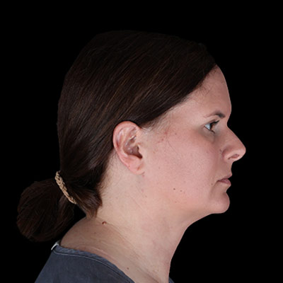 After Image: Neck Lipo - right-side