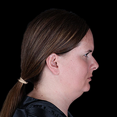 Before Image: Neck Lipo - right-side