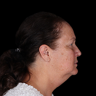 Before Image: Neck Lift - right-side