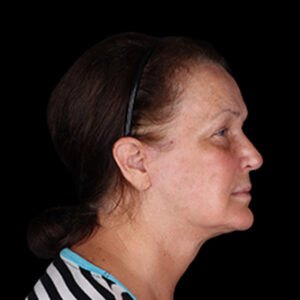 After Image: Neck Lift