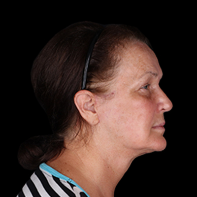 After Image: Neck Lift - right-side