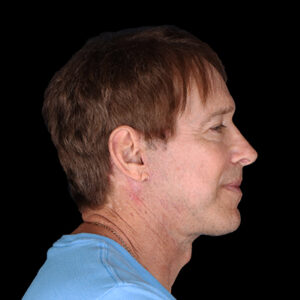 After Image: Neck Lift
