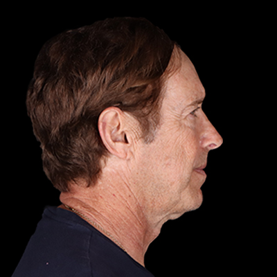 Before Image: Neck Lift - right-side