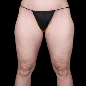 After Image: Thigh Lift