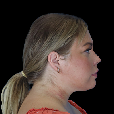 After Image: Neck Lipo - right-side