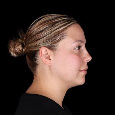 After Image: Neck Lipo - right-side