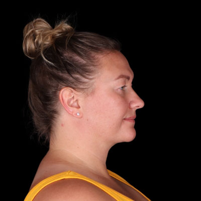 After Image: Neck Lipo - right-side