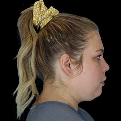 Before Image: Neck Lipo - right-side