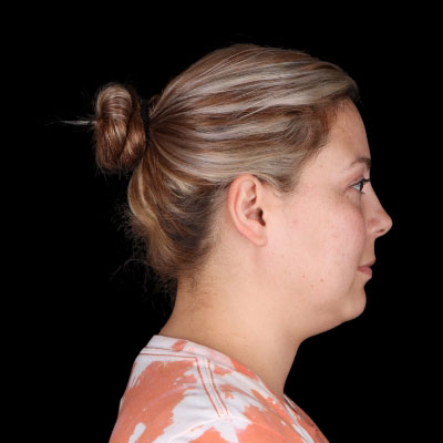 Before Image: Neck Lipo - right-side