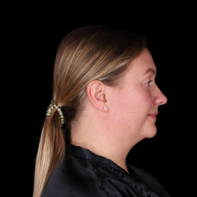 Before Image: Neck Lipo - right-side