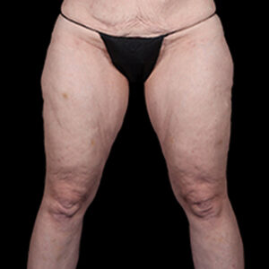 Before Image: Thigh Lift