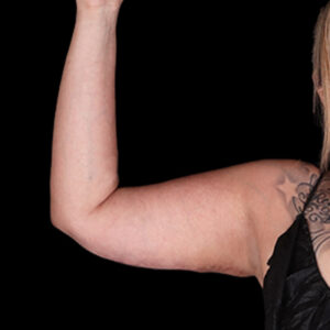 After Image: Arm Lift