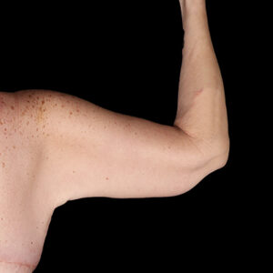 After Image: Arm Lift
