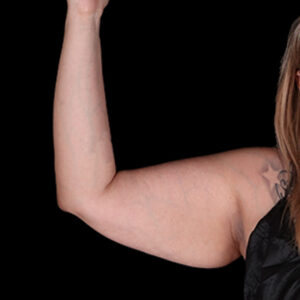 Before Image: Arm Lift