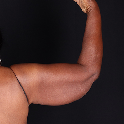 Before Image: Arm Lift - front