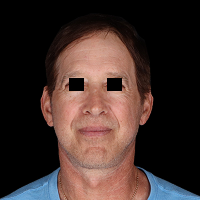 After Image: Facelift - front