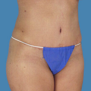 After Image: LipoTuck