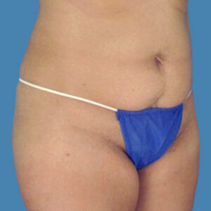Before Image: LipoTuck