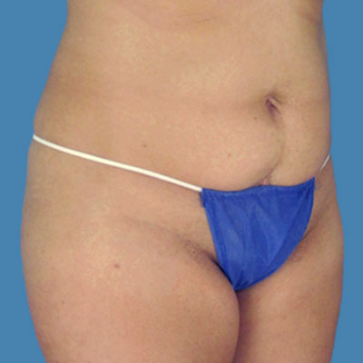 Before Image: LipoTuck - front