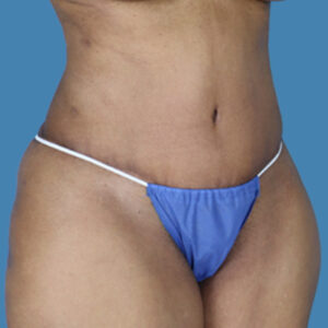After Image: LipoTuck