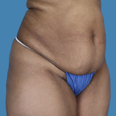 Before Image: LipoTuck - front