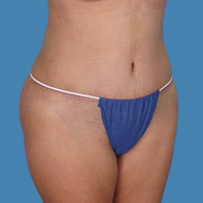 After Image: LipoTucj - front