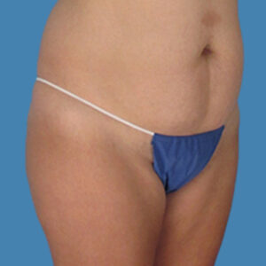Before Image: LipoTucj