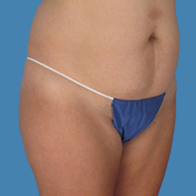Before Image: LipoTucj - front