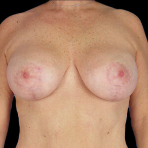 After Image: Breast Lift