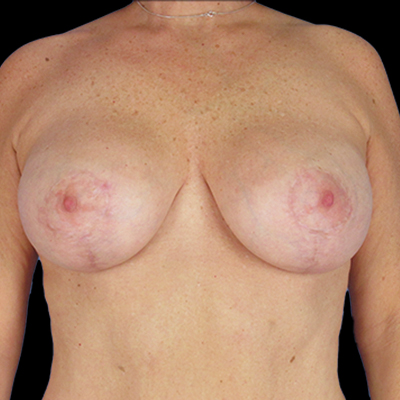 After Image: Breast Lift - front