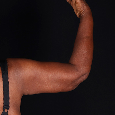 After Image: Arm Lift - front