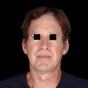 Before Image: Facelift