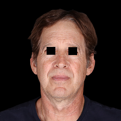 Before Image: Facelift - front