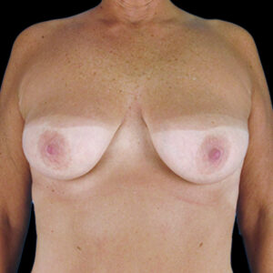 Before Image: Breast Lift