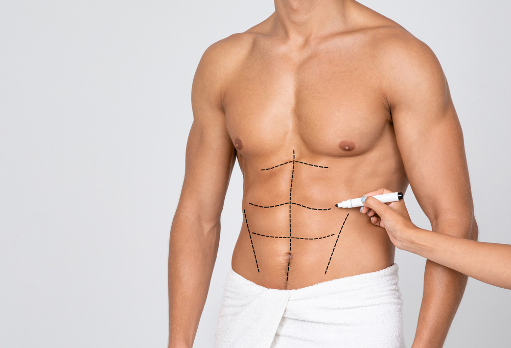 Man's fit torso with surgical lines drawn by doctor before plastic surgery, showing preoperative markings for body contouring.