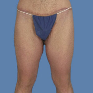 Thigh Lift After