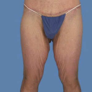thigh lift before
