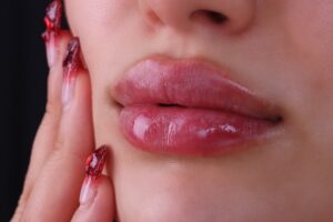 Close-up of woman receiving lip filler or lip flip treatment, highlighting non-surgical cosmetic enhancement for fuller, more defined lips