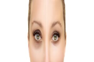 Close-up of a tear trough filler procedure, addressing A-frame deformity with hyaluronic acid injections to restore volume and rejuvenate under-eye hollows