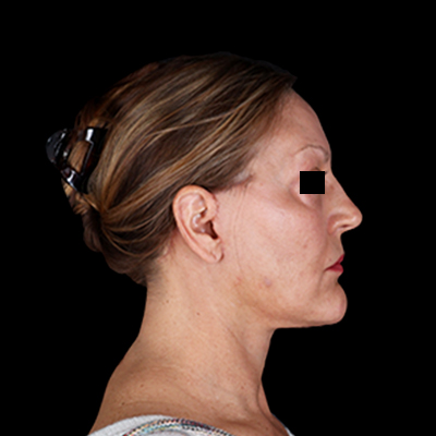After Image: Neck Lift - right-side